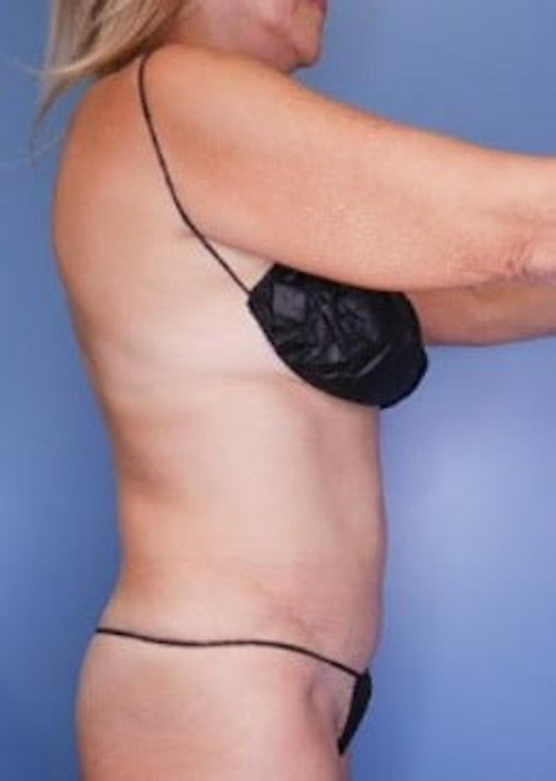 Vaser Liposuction Before & After Gallery - Patient 133182825 - Image 2