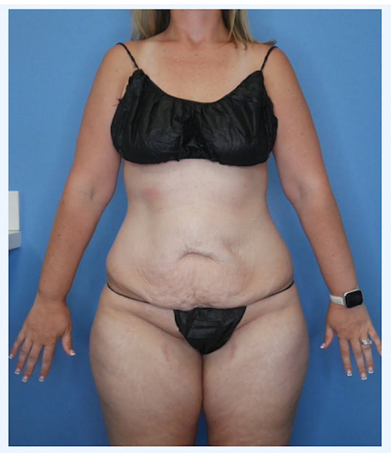 Tummy Tuck (Abdominoplasty)  Before & After Gallery - Patient 133182832 - Image 1
