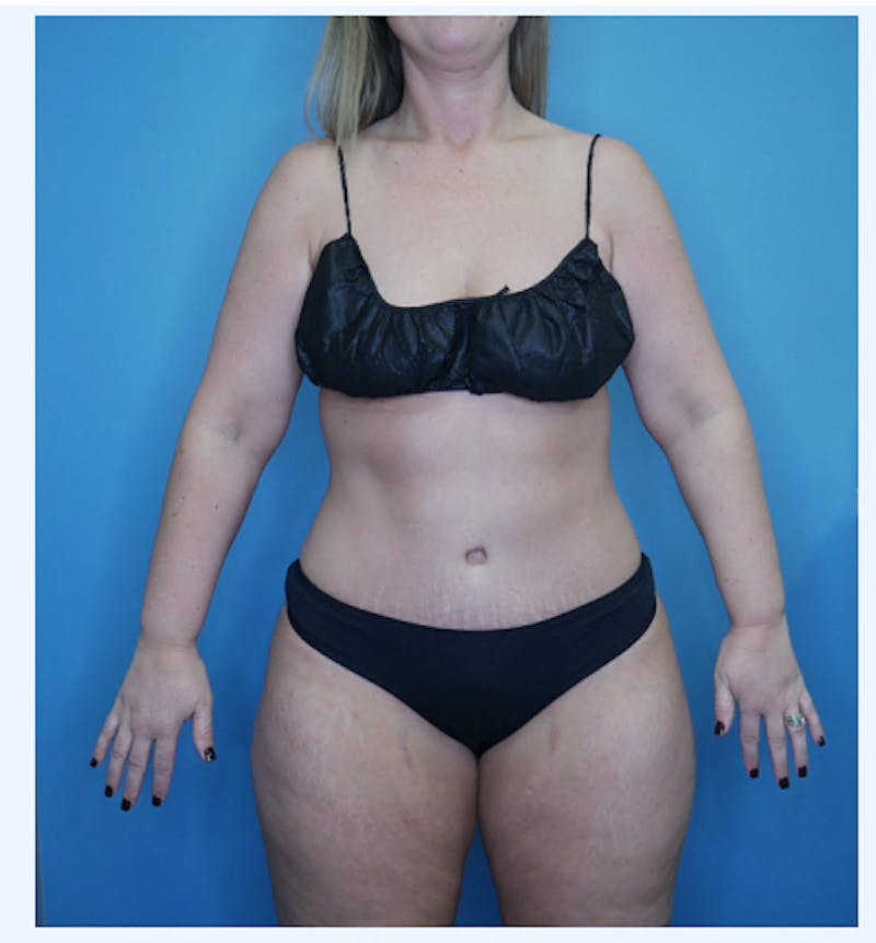 Tummy Tuck (Abdominoplasty)  Before & After Gallery - Patient 133182832 - Image 2