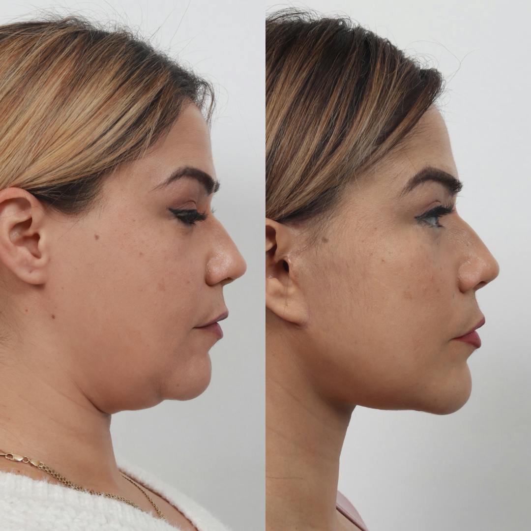 Deep Neck Lift Before & After Gallery - Patient 133237716 - Image 4