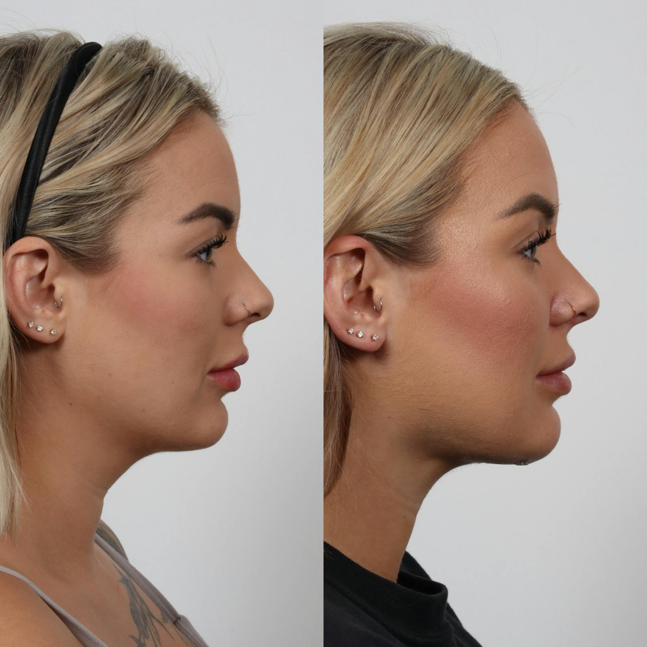 Deep Neck Lift Before & After Gallery - Patient 133237715 - Image 4