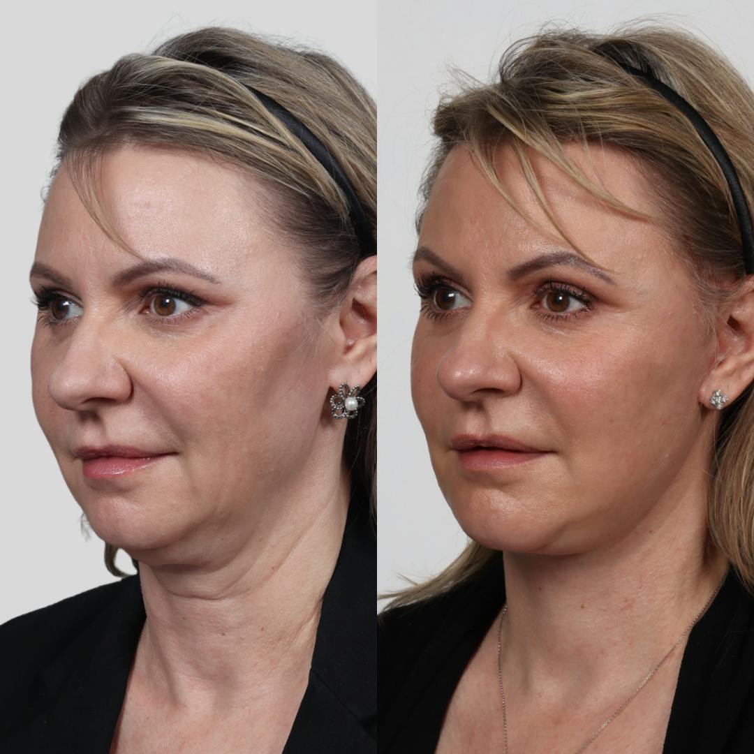 Deep Plane Facelift Before & After Gallery - Patient 133237790 - Image 2