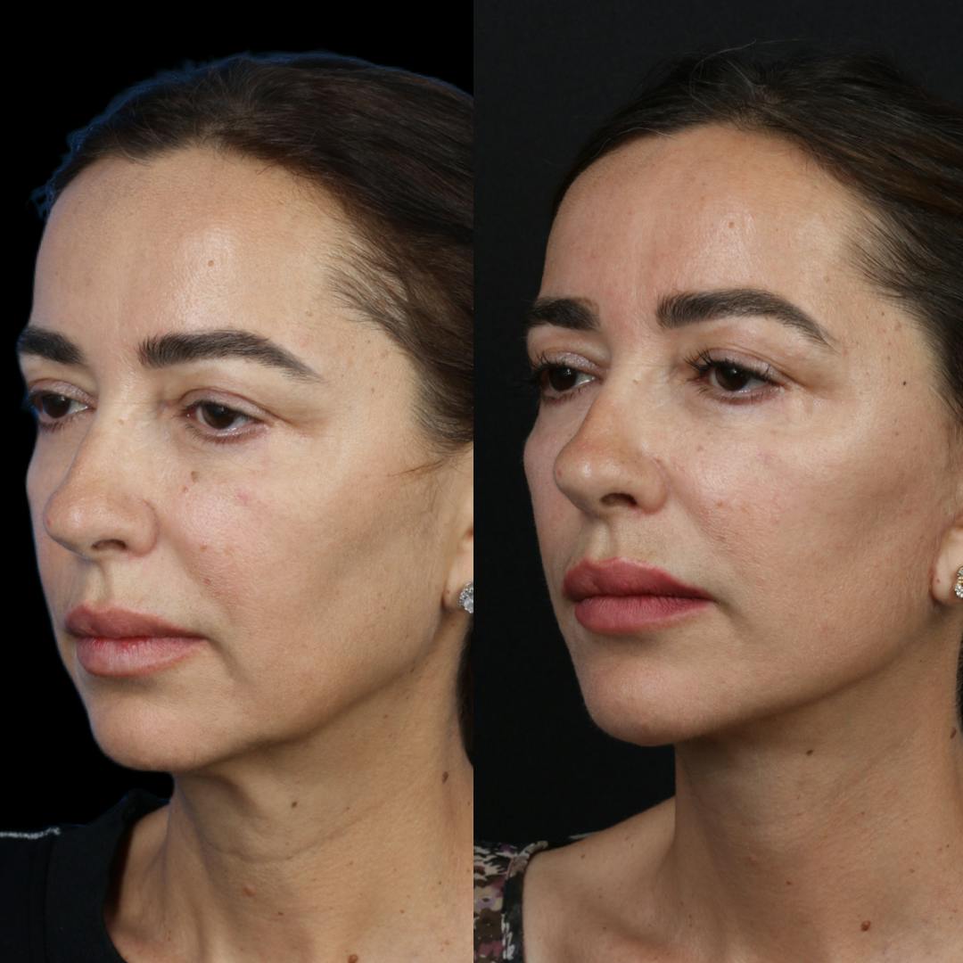 Deep Plane Facelift Before & After Gallery - Patient 55611648 - Image 3