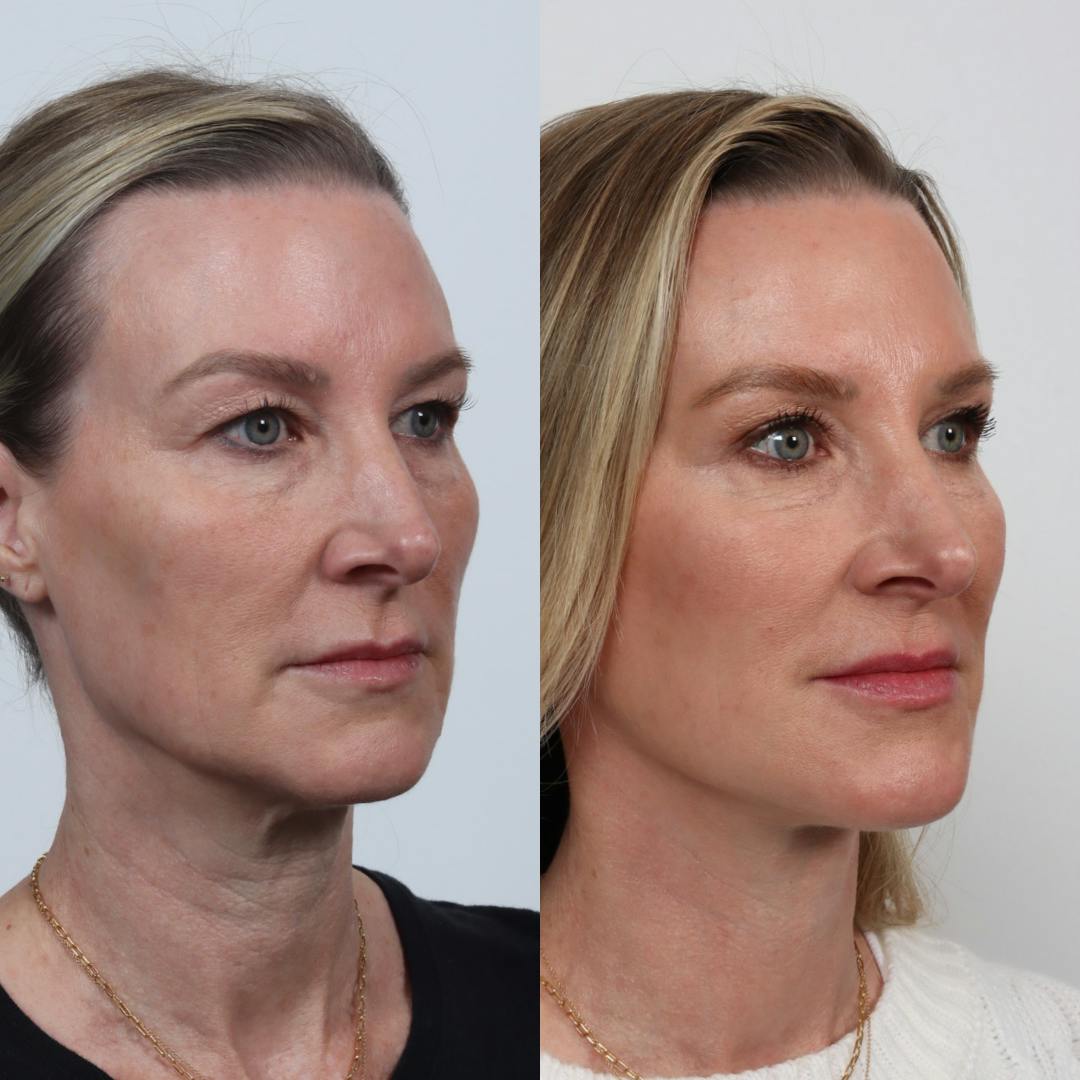 Deep Plane Facelift Before & After Gallery - Patient 133237729 - Image 2