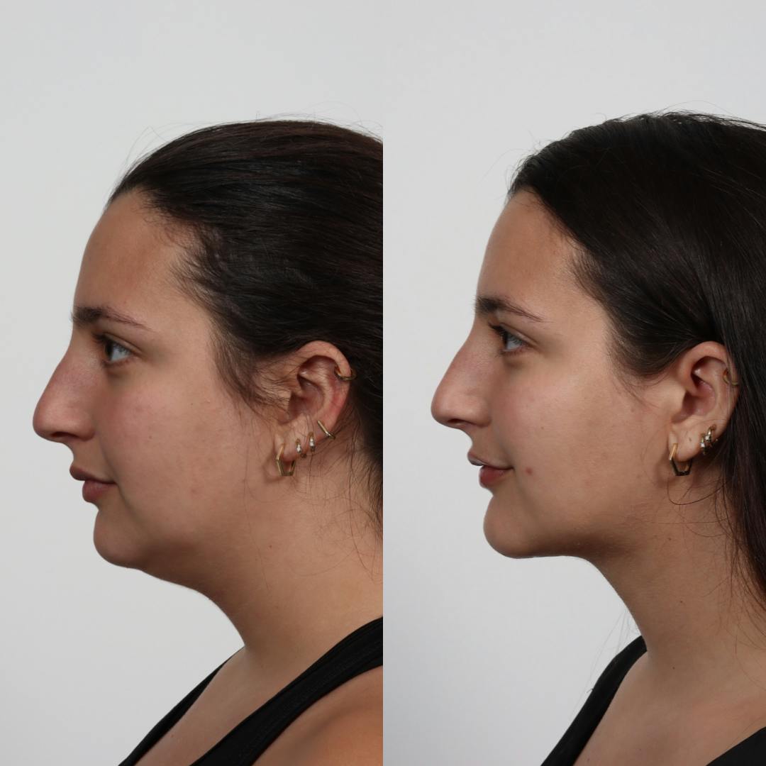 Deep Neck Lift Before & After Gallery - Patient 100876850 - Image 1