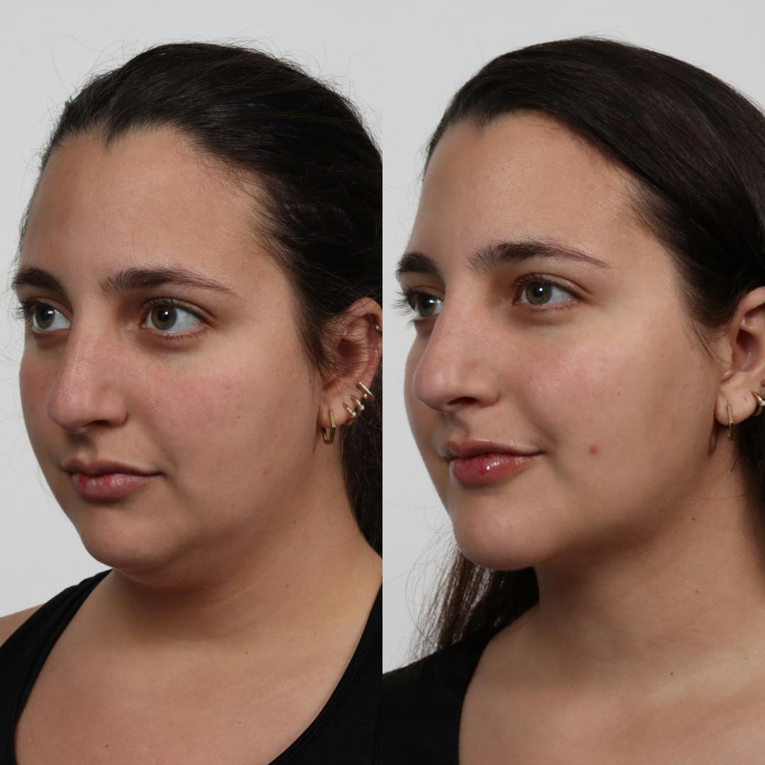 Deep Neck Lift Before & After Gallery - Patient 100876850 - Image 4
