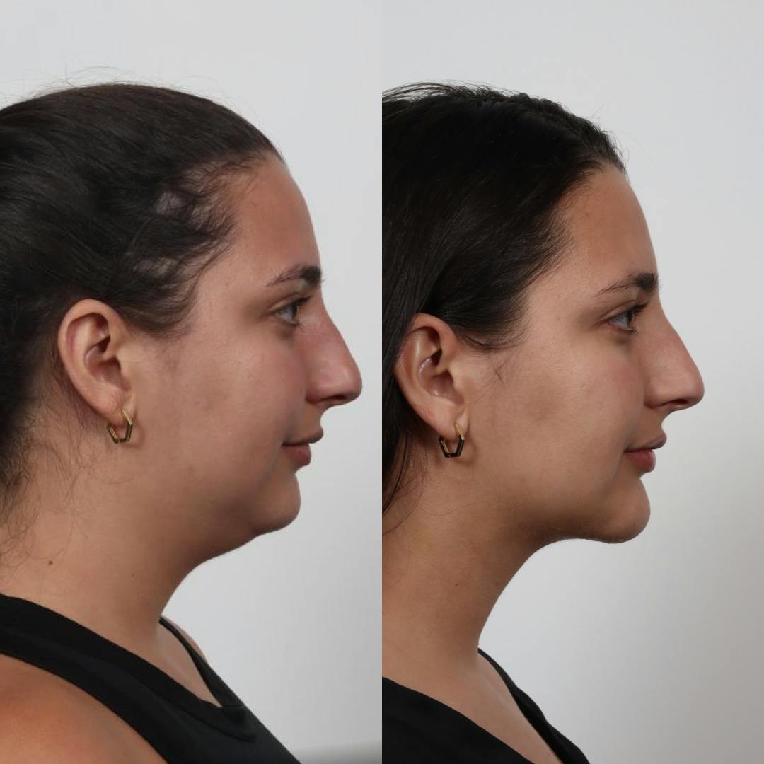 Deep Neck Lift Before & After Gallery - Patient 100876850 - Image 3