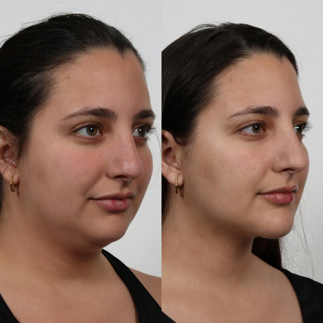 Deep Neck Lift Before & After Gallery - Patient 100876850 - Image 2