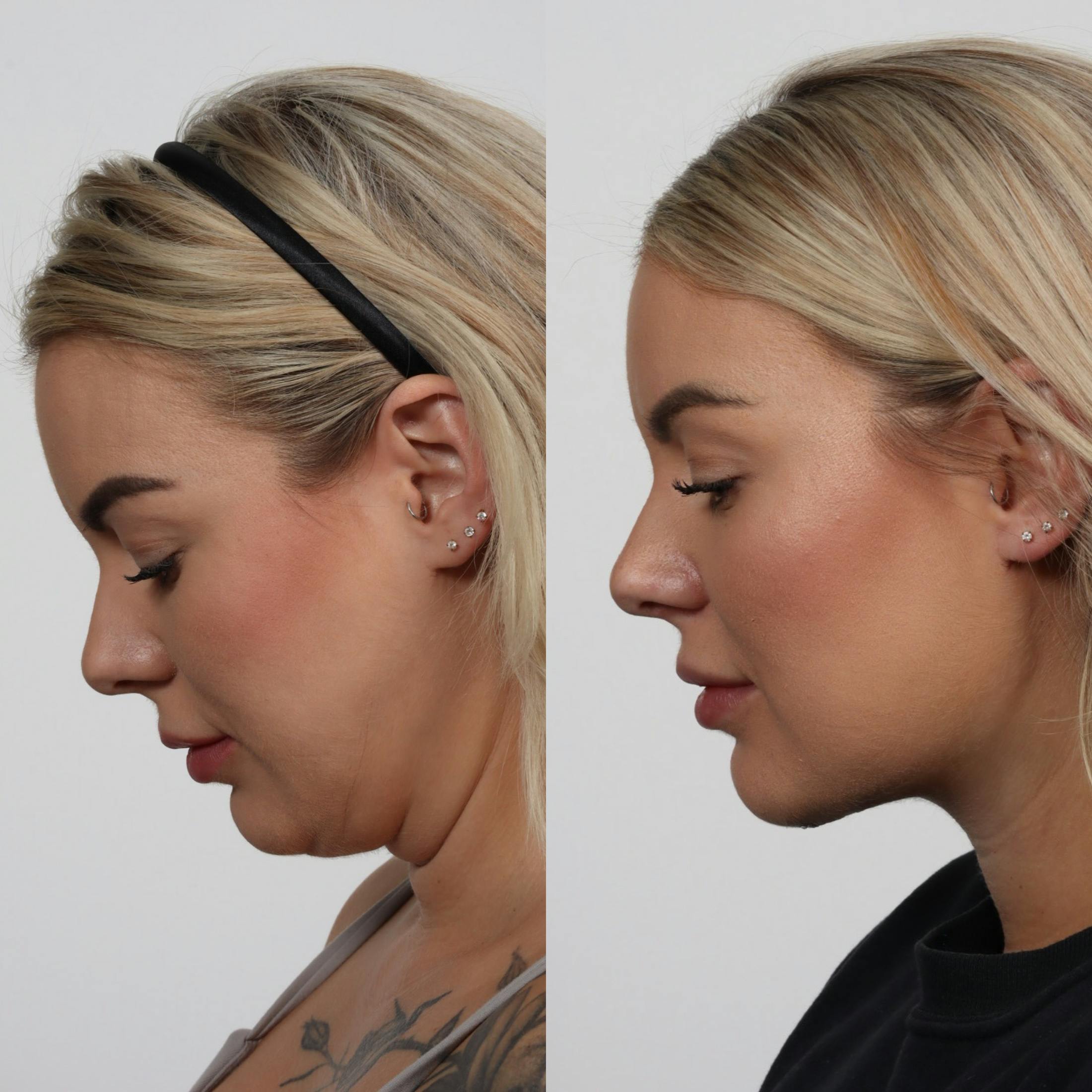 Deep Neck Lift Before & After Gallery - Patient 133237715 - Image 2