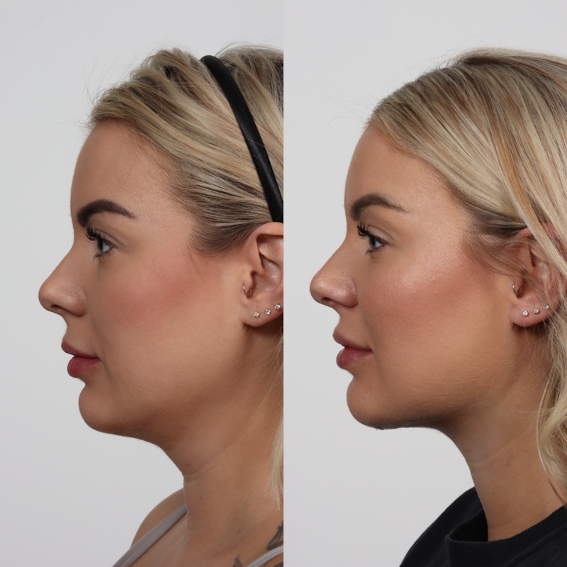 Deep Neck Lift Before & After Gallery - Patient 133237715 - Image 1