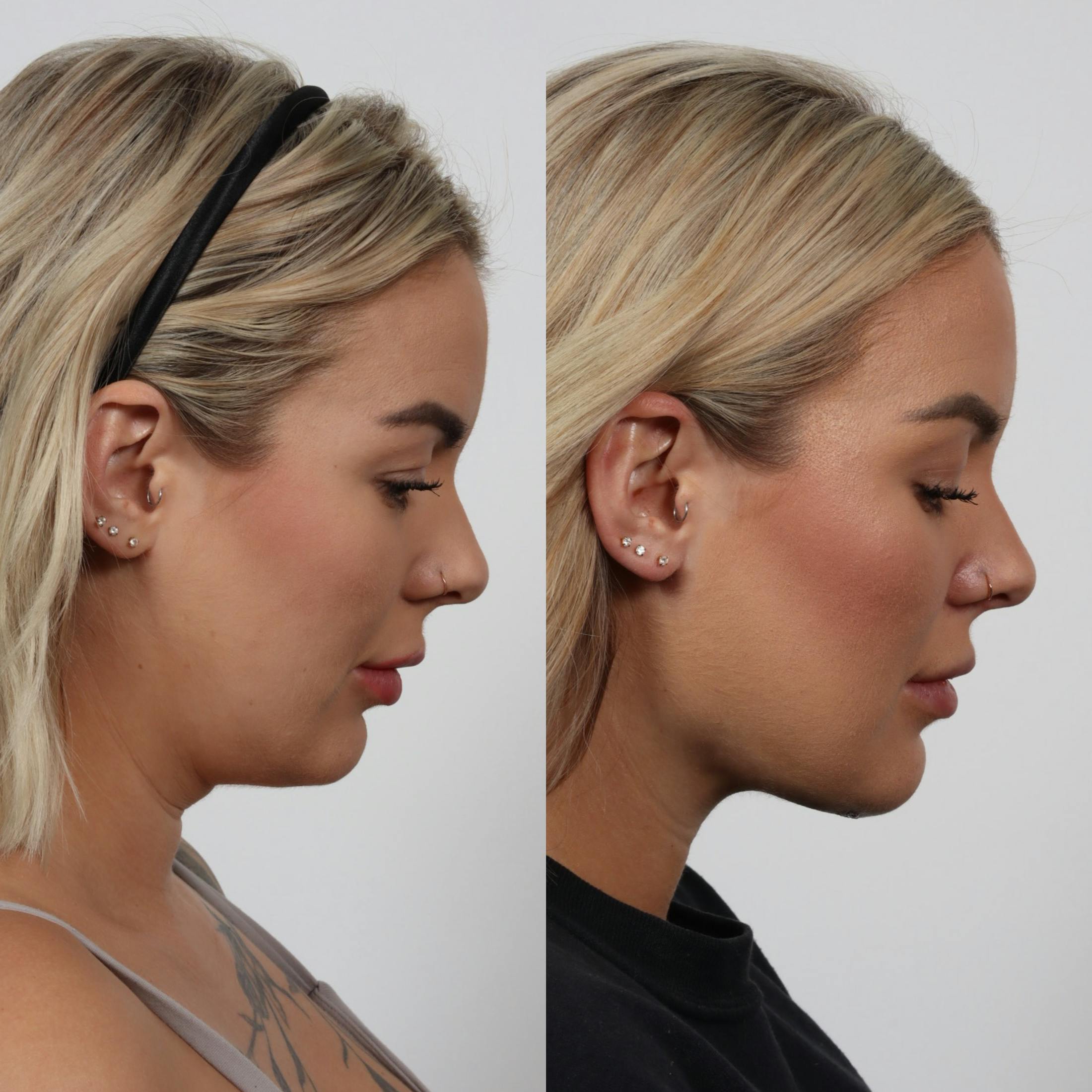 Deep Neck Lift Before & After Gallery - Patient 133237715 - Image 3