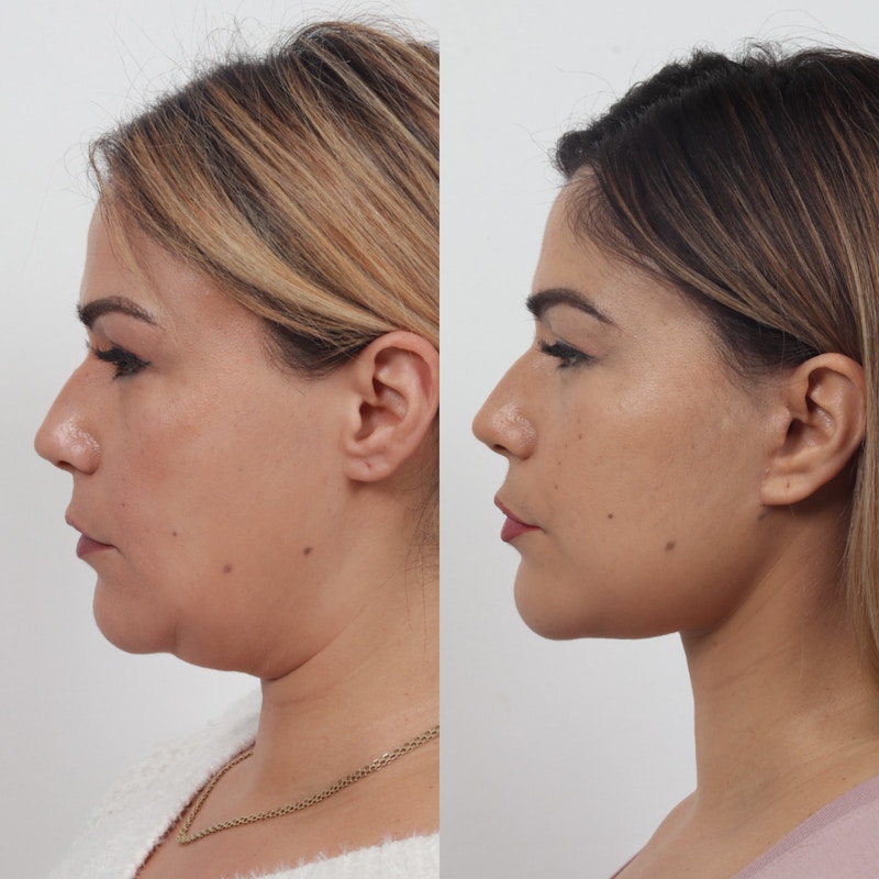 Deep Neck Lift Before & After Gallery - Patient 133237716 - Image 1