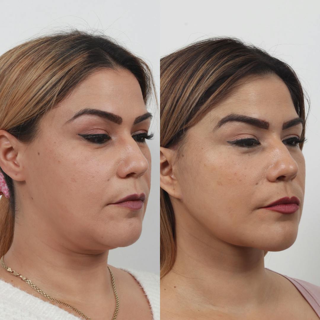 Deep Neck Lift Before & After Gallery - Patient 133237716 - Image 2
