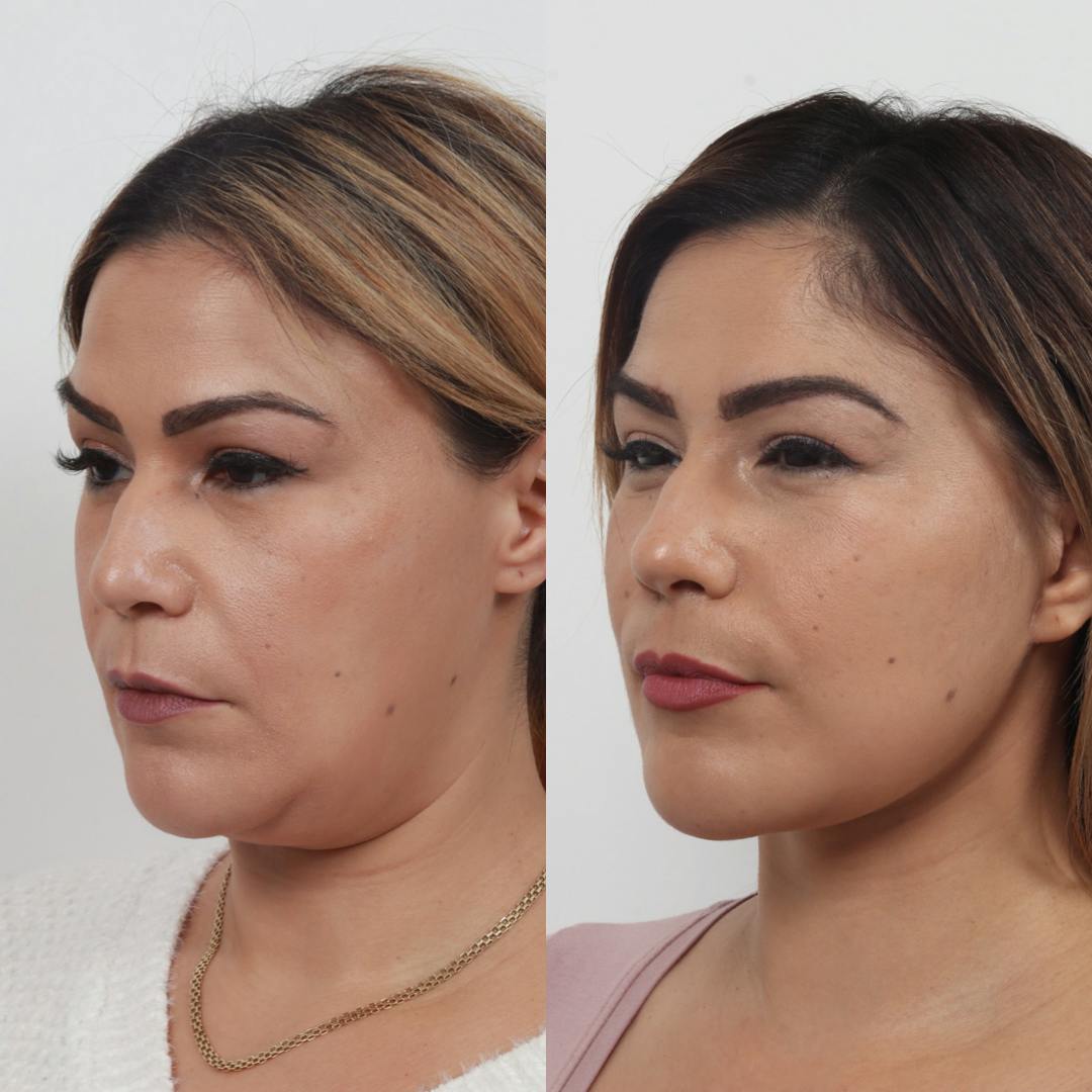 Deep Neck Lift Before & After Gallery - Patient 133237716 - Image 3