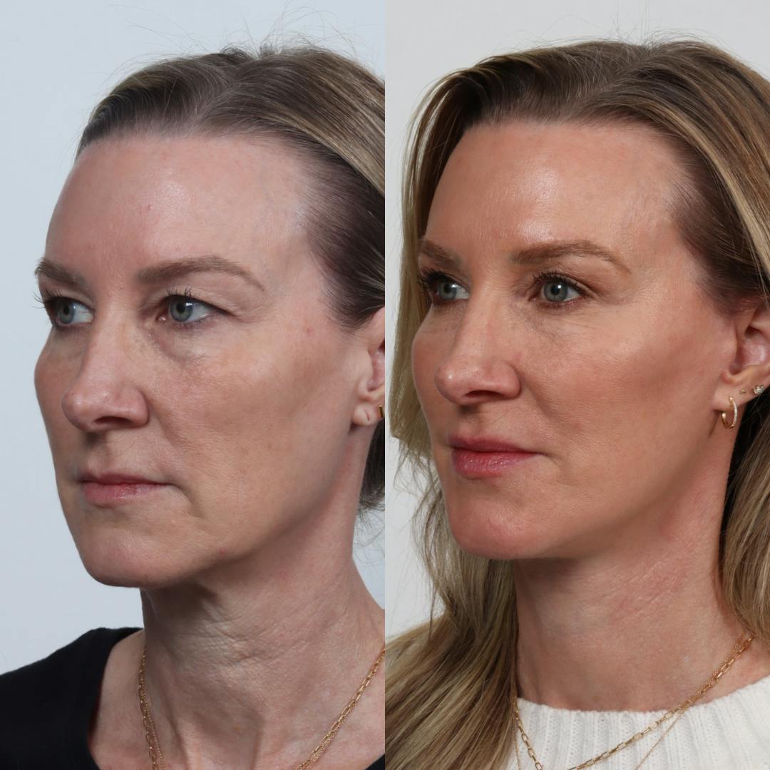 Deep Plane Facelift Before & After Gallery - Patient 133237729 - Image 1