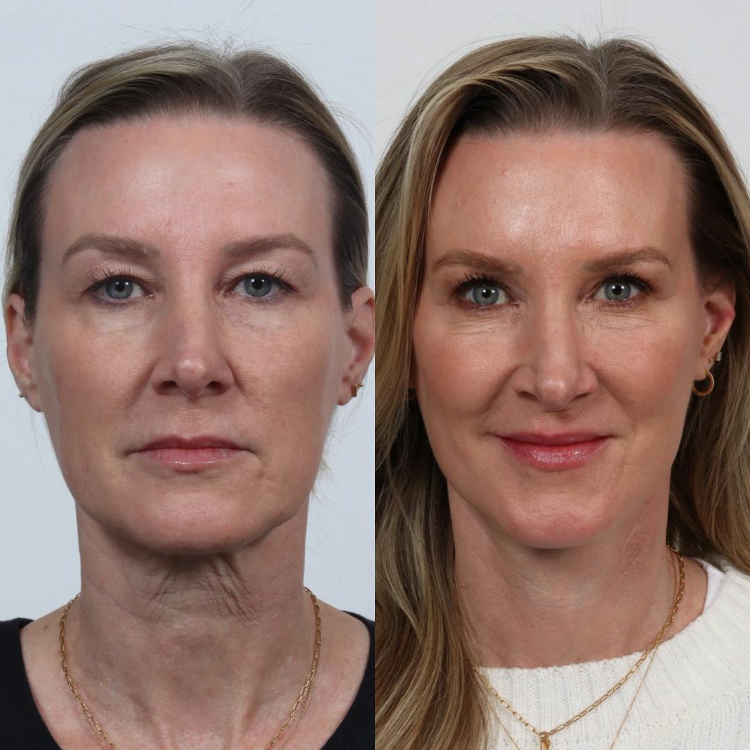 Deep Plane Facelift Before & After Gallery - Patient 133237729 - Image 3