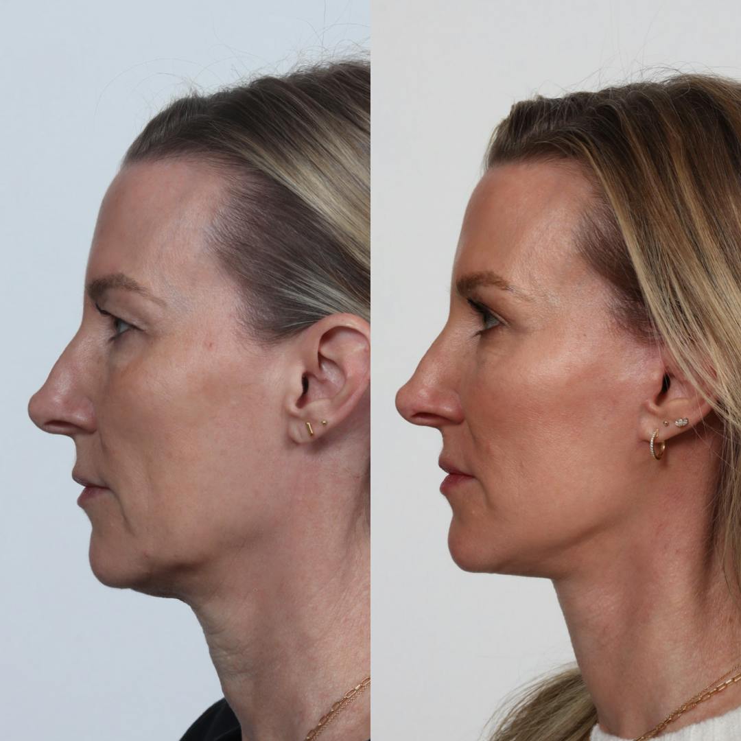 Deep Plane Facelift Before & After Gallery - Patient 133237729 - Image 4