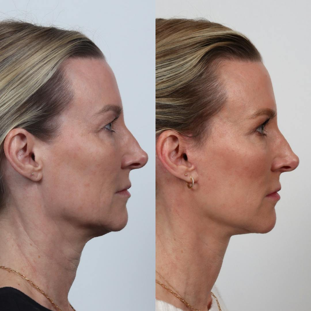 Deep Plane Facelift Before & After Gallery - Patient 133237729 - Image 5