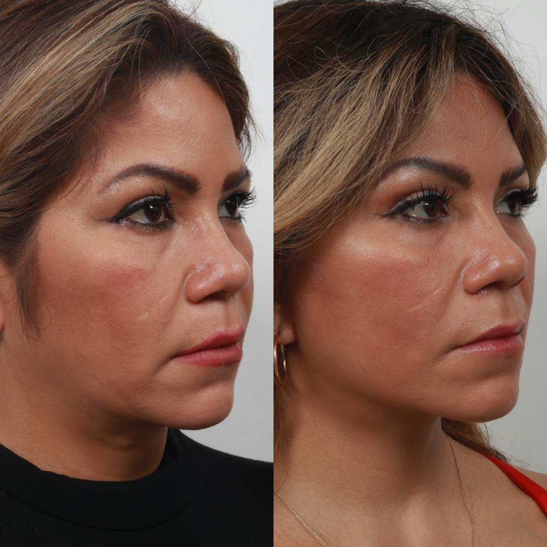 Deep Plane Facelift Before & After Gallery - Patient 55611647 - Image 6