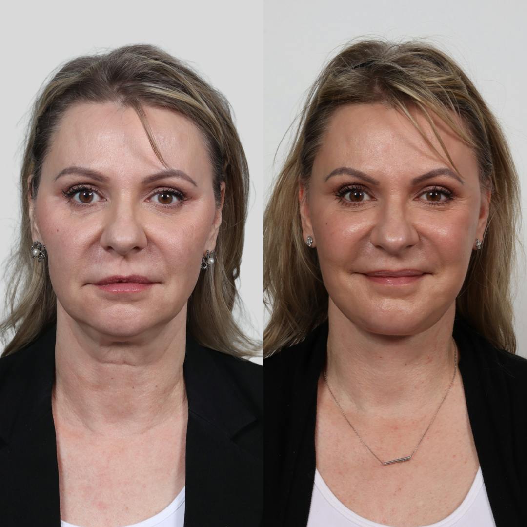 Deep Plane Facelift Before & After Gallery - Patient 133237790 - Image 1