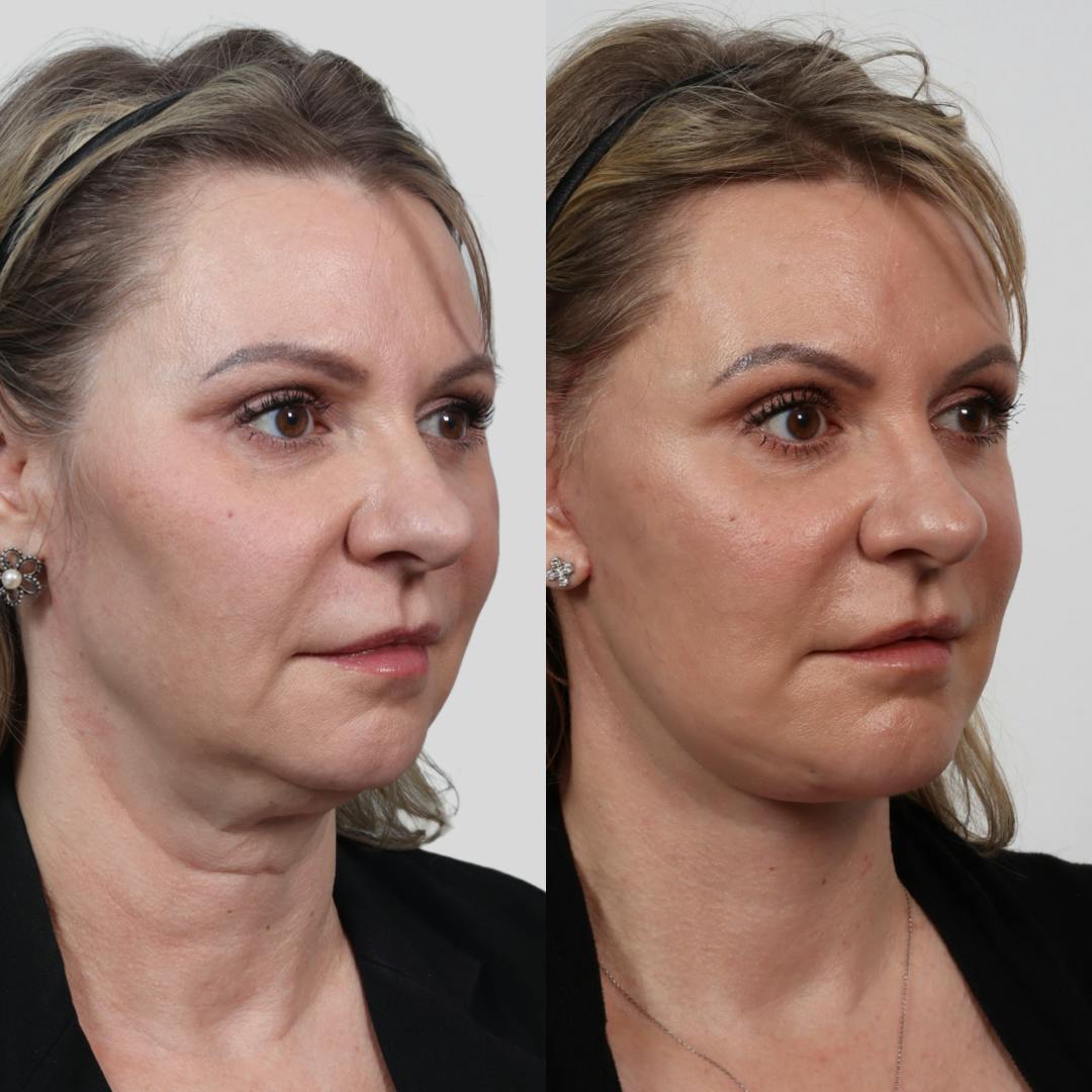 Deep Plane Facelift Before & After Gallery - Patient 133237790 - Image 3