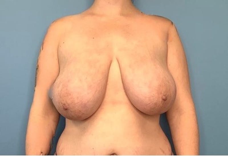 Breast Reduction Before & After Gallery - Patient 133227831 - Image 1