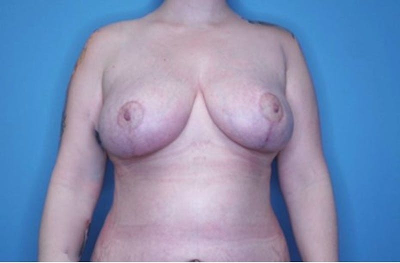 Breast Reduction Before & After Gallery - Patient 133227831 - Image 2
