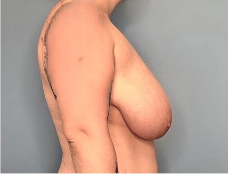 Breast Reduction Before & After Gallery - Patient 133227831 - Image 3