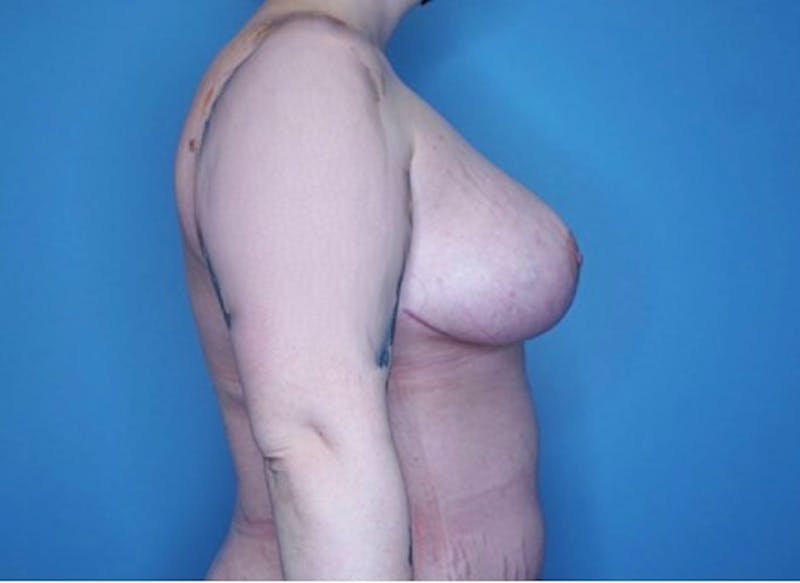 Breast Reduction Before & After Gallery - Patient 133227831 - Image 4