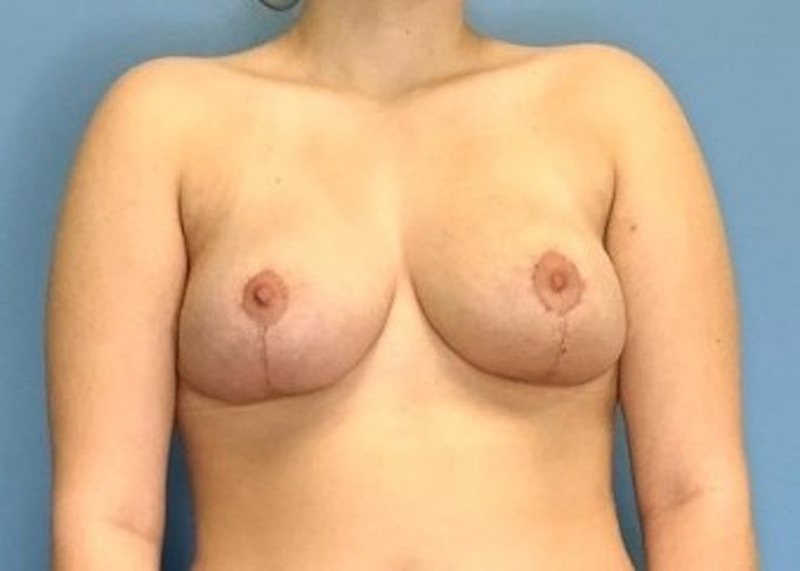 Breast Reduction Before & After Gallery - Patient 133227898 - Image 2