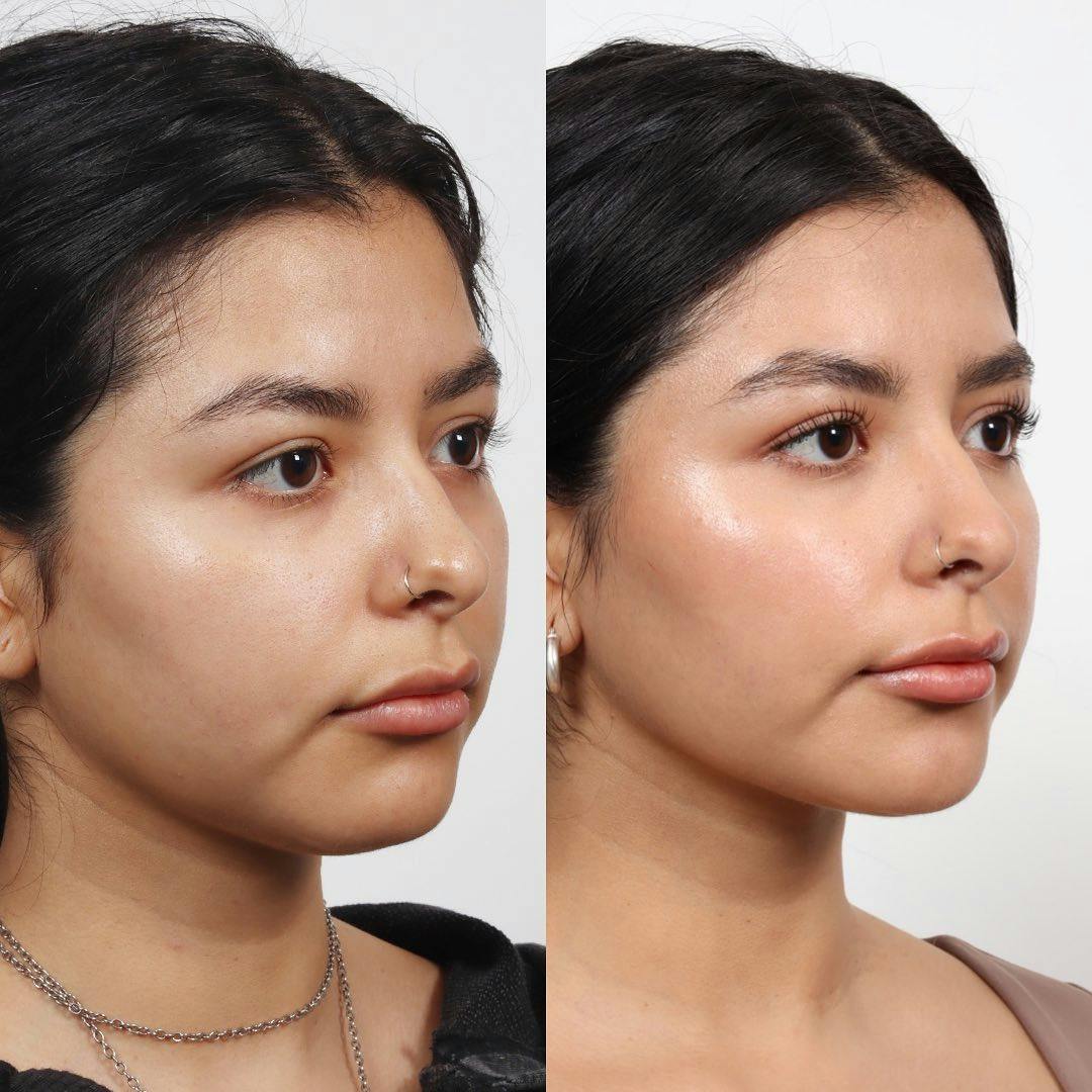 Submental Liposuction Before & After Gallery - Patient 133237826 - Image 3