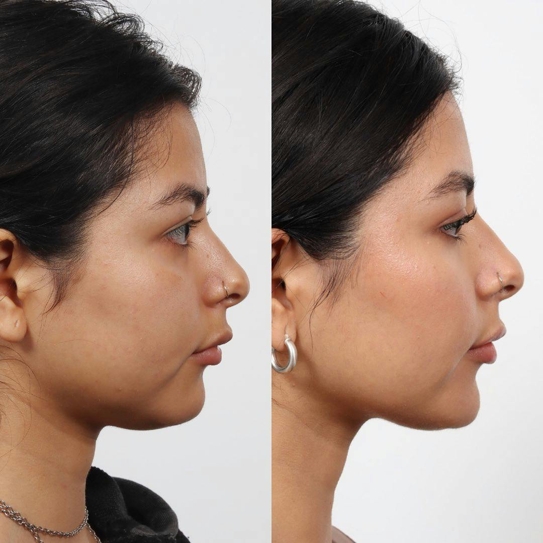 Buccal Fat Reduction Before & After Gallery - Patient 133237827 - Image 5