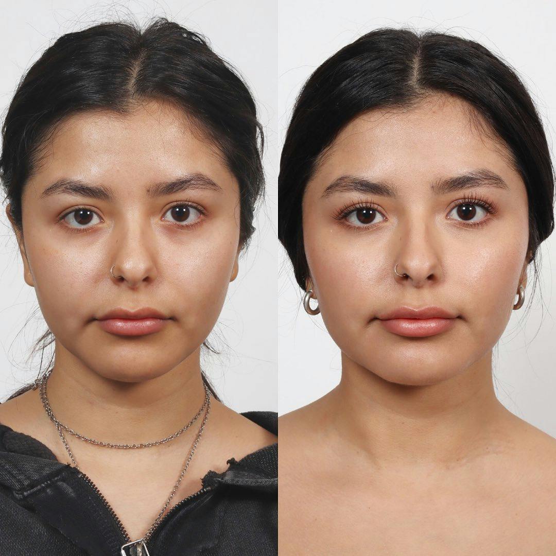 Buccal Fat Reduction Before & After Gallery - Patient 133237827 - Image 1
