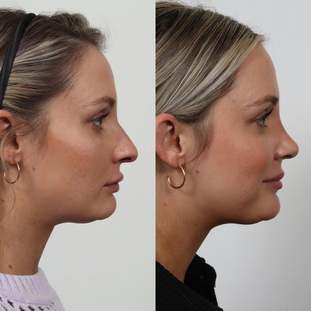 Rhinoplasty Before & After Gallery - Patient 133237834 - Image 5