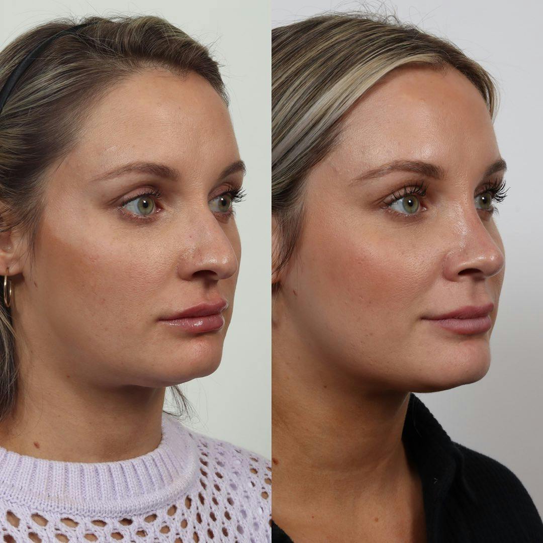 Rhinoplasty Before & After Gallery - Patient 133237834 - Image 3