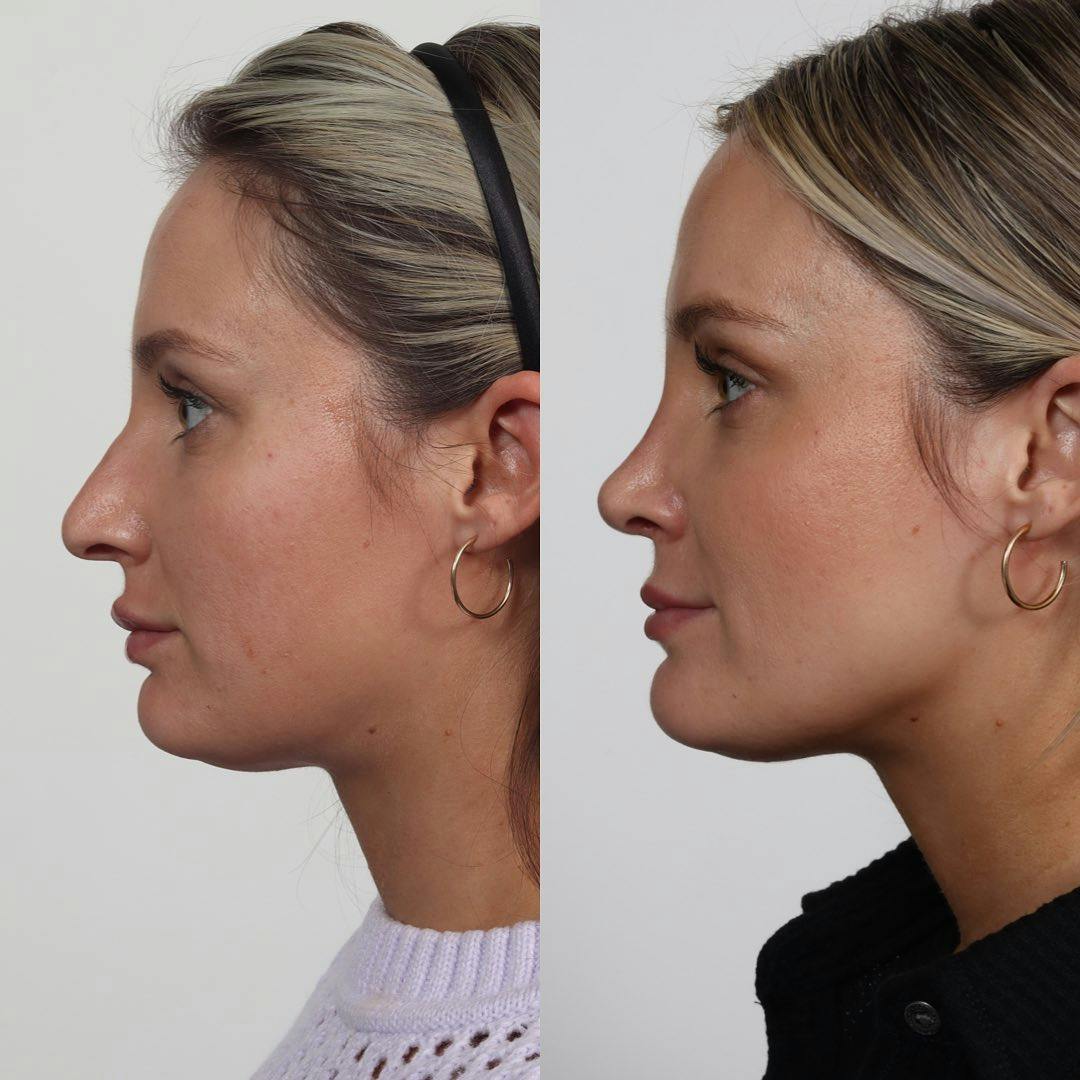 Rhinoplasty Before & After Gallery - Patient 133237834 - Image 1