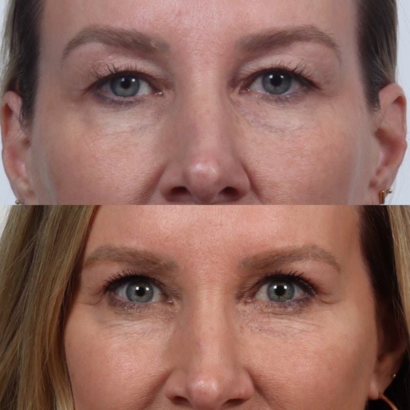 Eyelid Surgery (Blepharoplasty) Before & After Gallery - Patient 133237841 - Image 1
