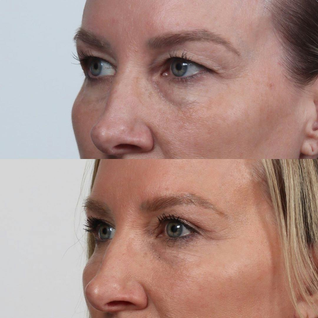 Eyelid Surgery Before & After Gallery - Patient 133237841 - Image 2