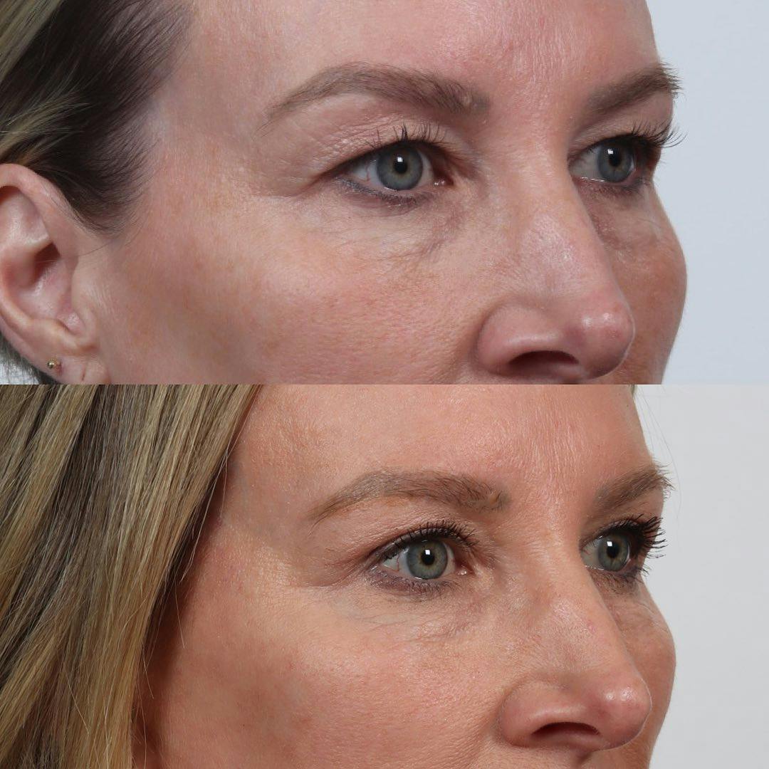 Eyelid Surgery Before & After Gallery - Patient 133237841 - Image 3