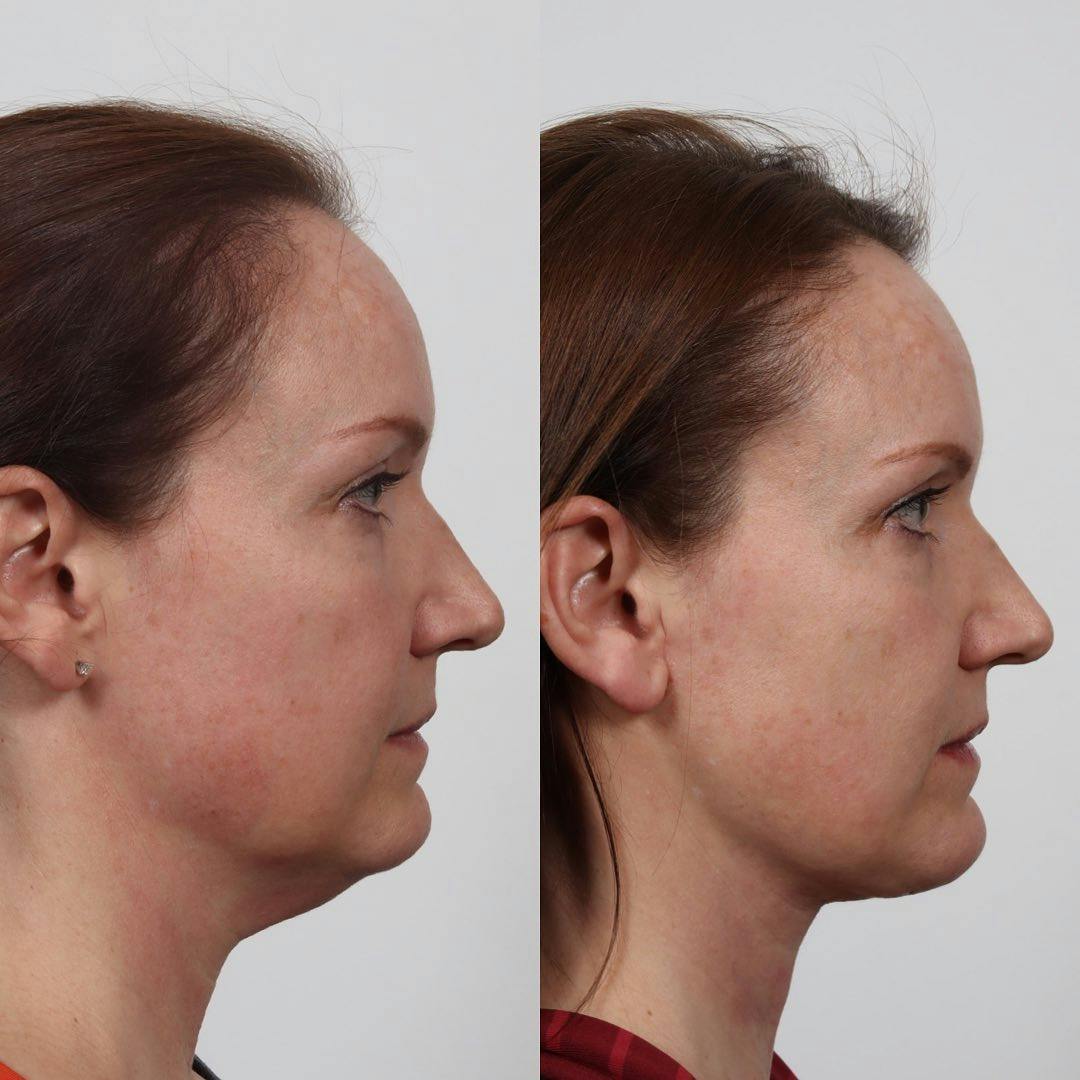 Deep Neck Lift Before & After Gallery - Patient 133237844 - Image 1