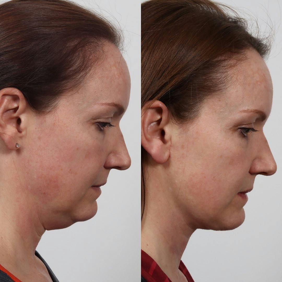Deep Neck Lift Before & After Gallery - Patient 133237844 - Image 2