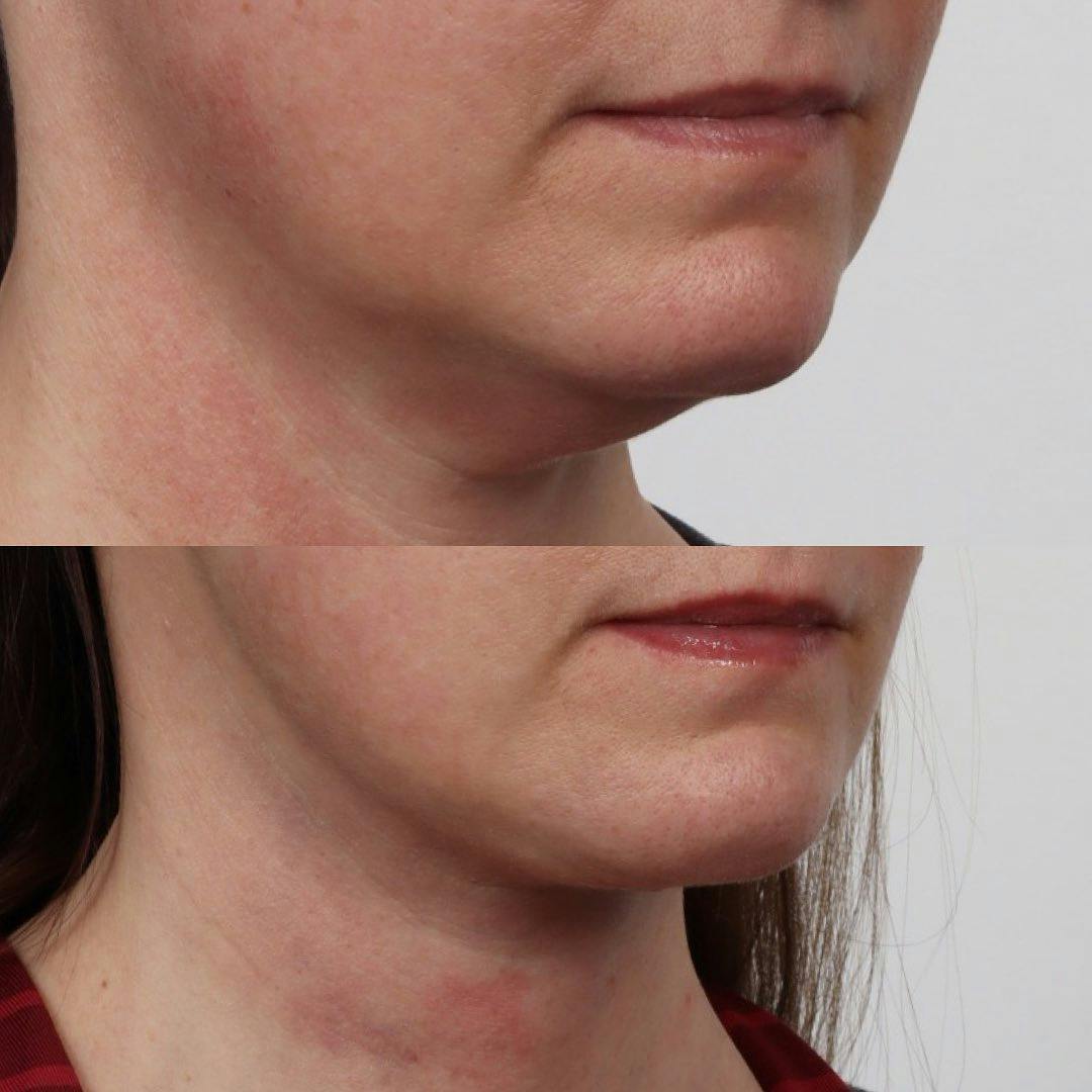 Deep Neck Lift Before & After Gallery - Patient 133237844 - Image 4