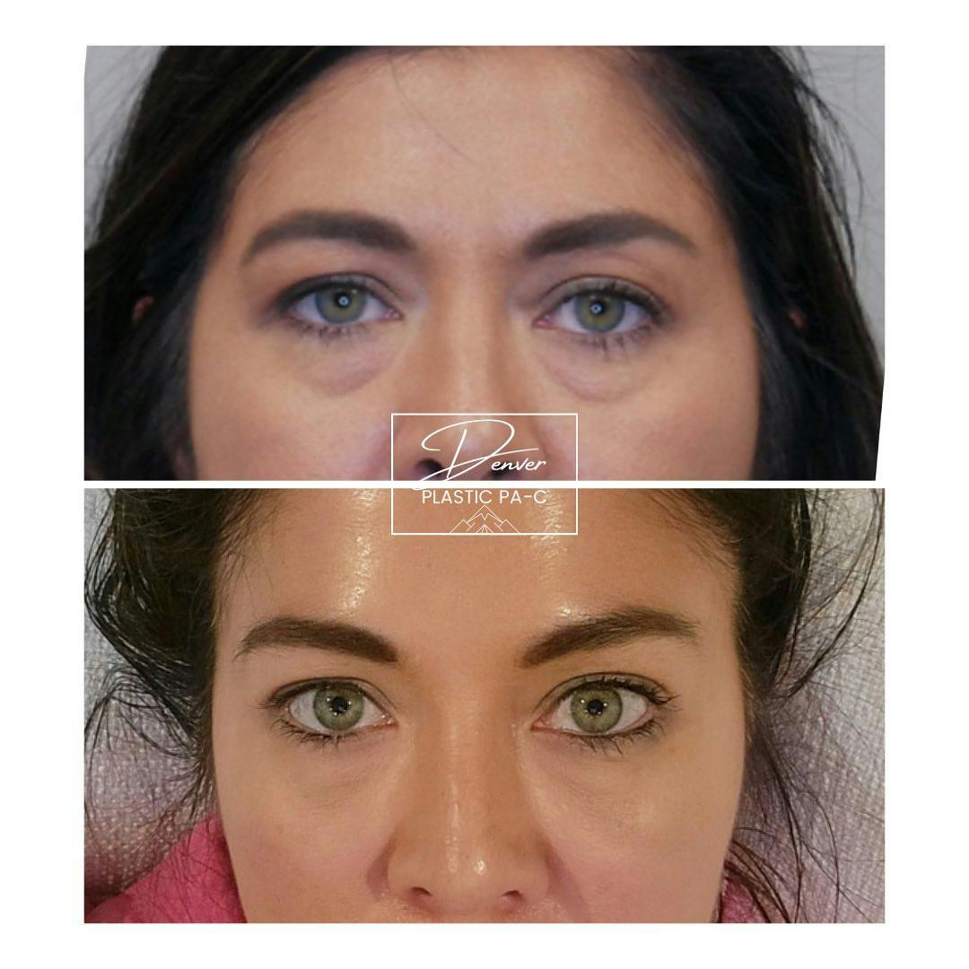 Under Eye Filler Before & After Gallery - Patient 133244713 - Image 1