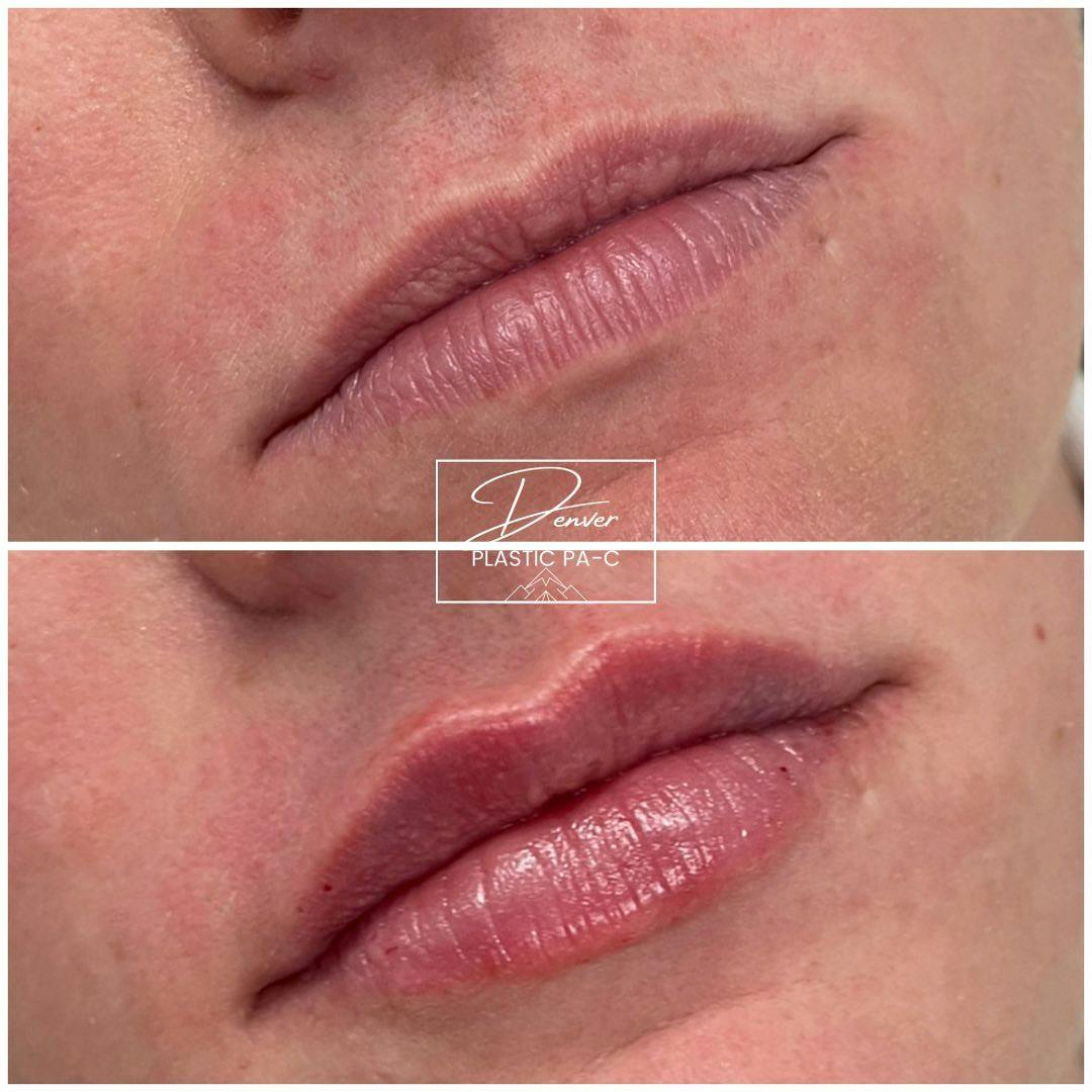Lip Fillers Before & After Gallery - Patient 152568663 - Image 2