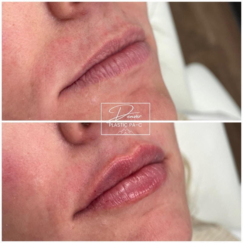 Lip Fillers Before & After Gallery - Patient 152568663 - Image 1