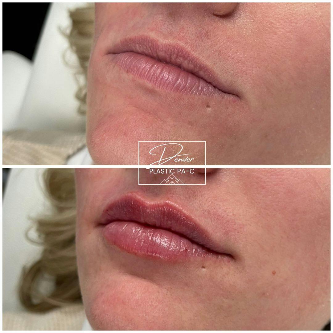 Lip Fillers Before & After Gallery - Patient 152568663 - Image 3