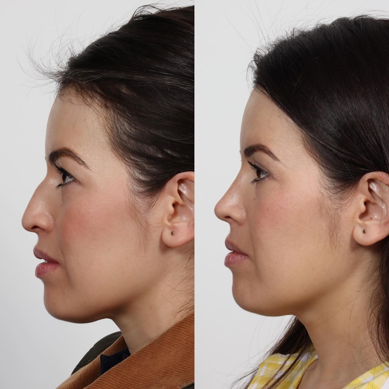 Rhinoplasty Before & After Gallery - Patient 152568665 - Image 1