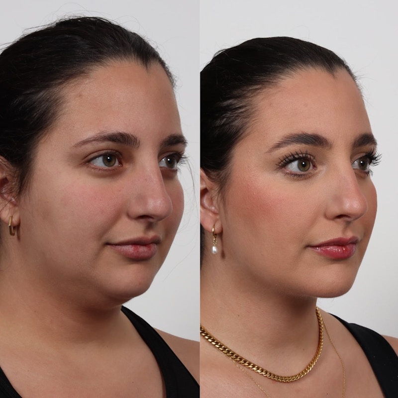 Buccal Fat Reduction Before & After Gallery - Patient 122965701 - Image 1