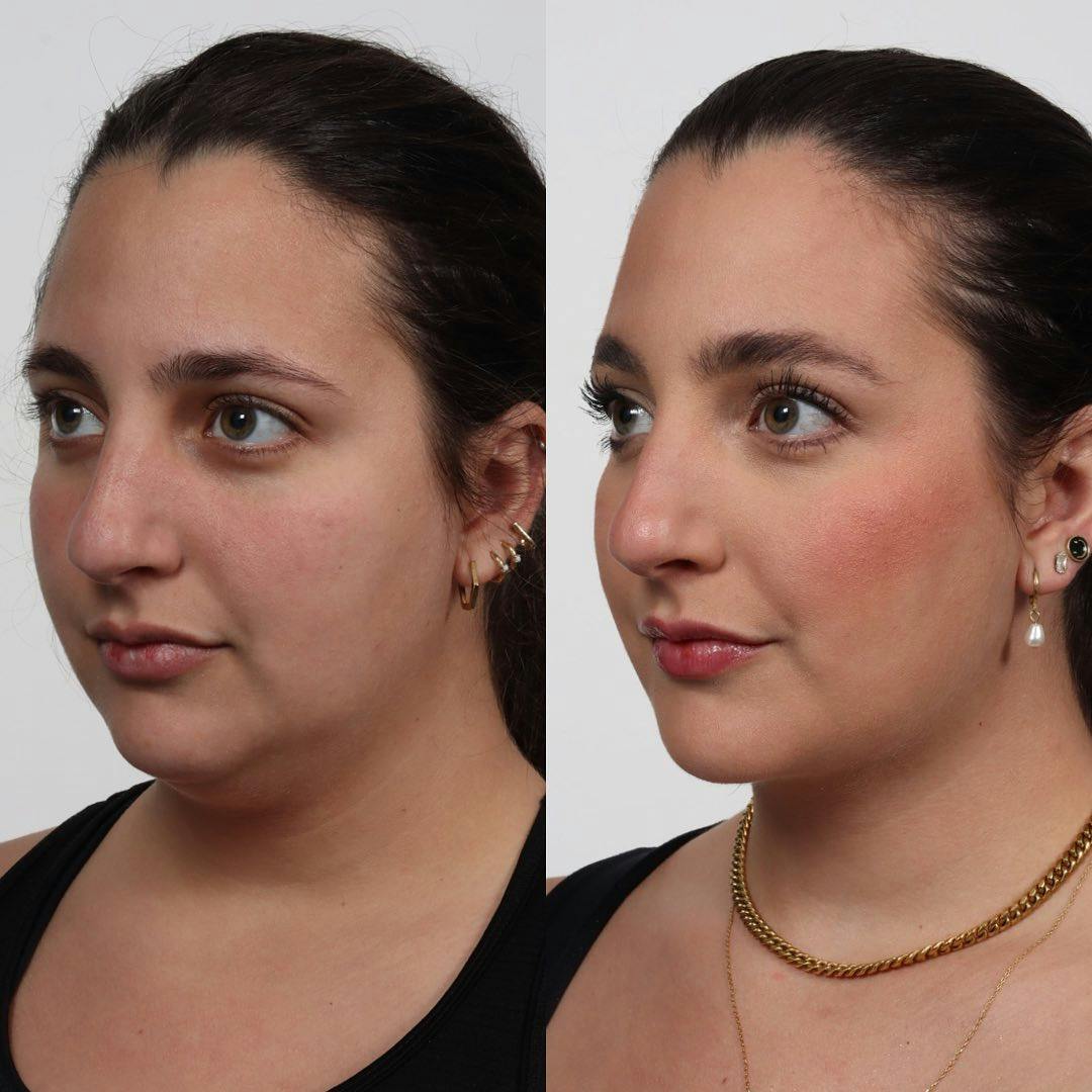 Buccal Fat Reduction Before & After Gallery - Patient 122965701 - Image 3