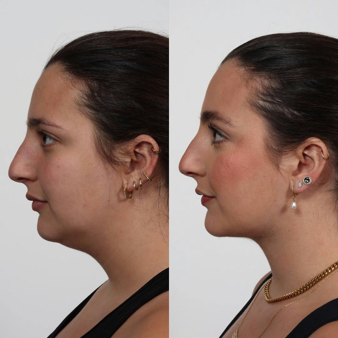 Buccal Fat Reduction Before & After Gallery - Patient 122965701 - Image 4